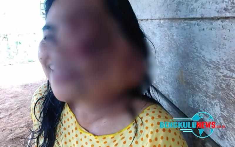 Menderita Tumor, Sunarmi Butuh Uluran Tangan Dermawan