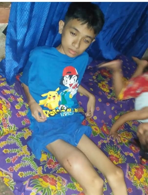 Jhordi, Penderita Tumor Paha Butuh Uluran Tangan