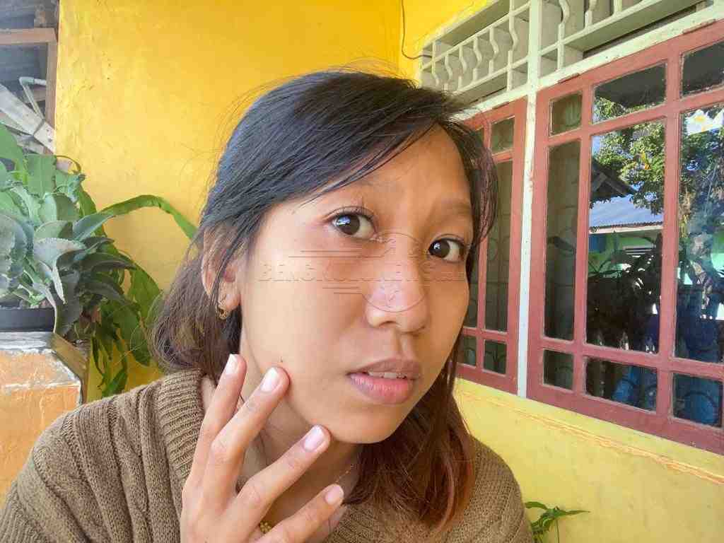 Apa Itu Milia? Ini Tips dan Cara Mengatasinya